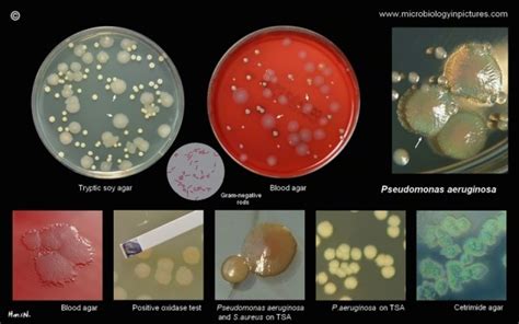 Pseudomonas aeruginosa: Infections, Pathogenesis and Lab Diag.